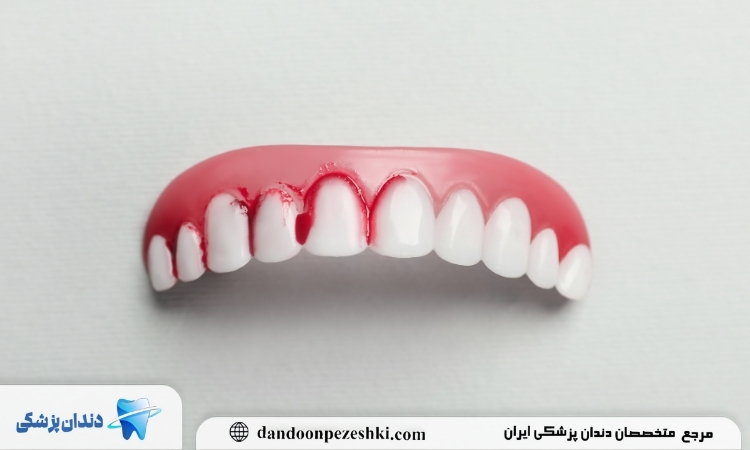 قطع فوری خونریزی دندان