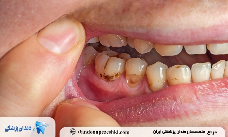 مصرف قلیان بعد کامپوزیت