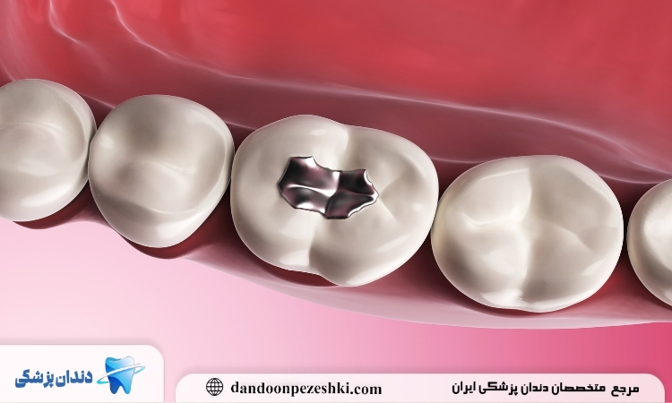 پر نکردن دندان