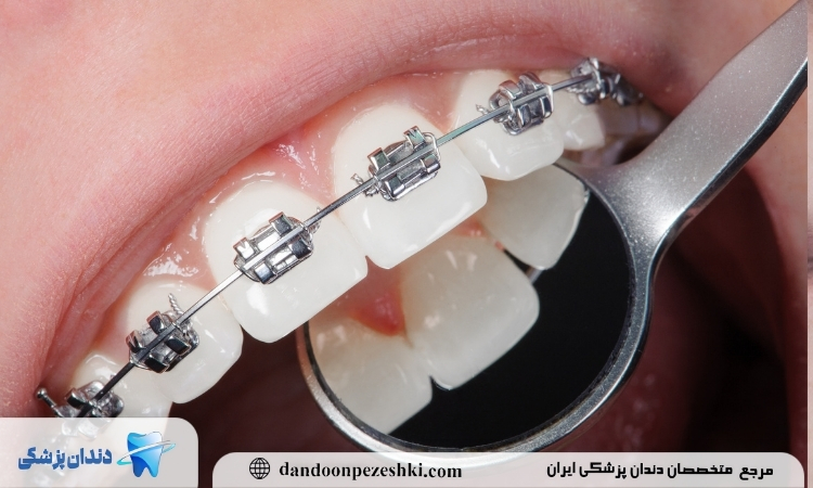 ارتودنسی دندان در بزرگسالی