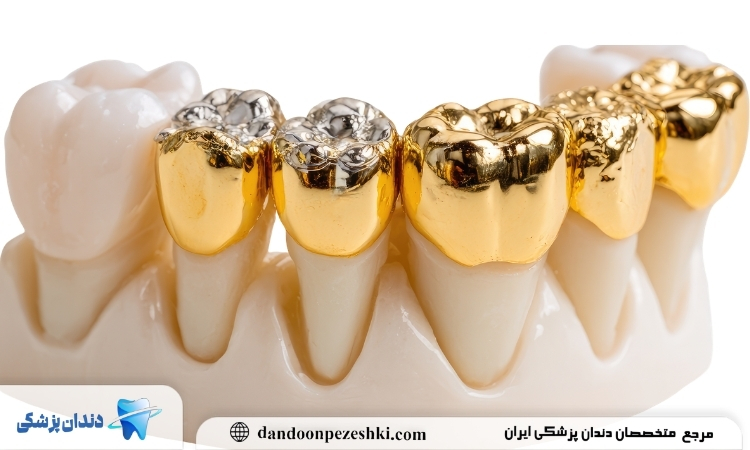 قیمت کاشت دندان طلا