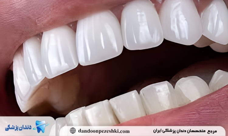 لمینت دندان سرامیکی