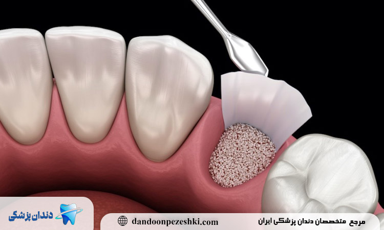 مدت زمان بهبود بعد از پیوند استخوان فک