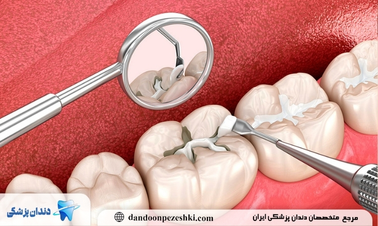 مدت زمان پر كردن دندان