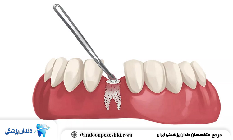 مراحل بهبودی استخوان فک