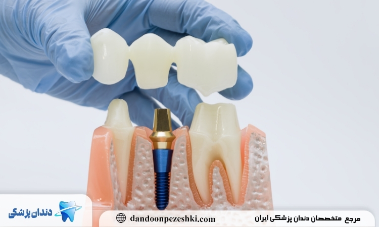 مراحل ساخت بریج دندان چگونه است؟