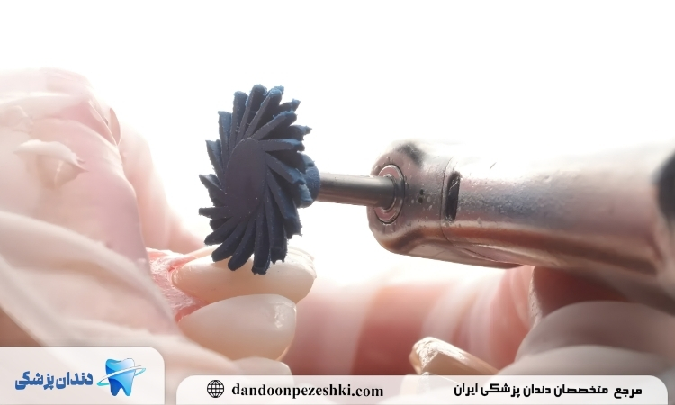 مراحل پالیش کامپوزیت دندان