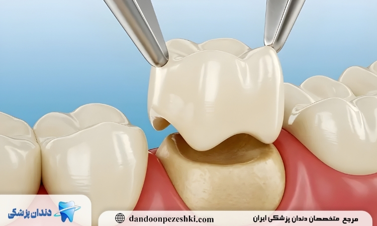 تغذیه بعد روکش دندان