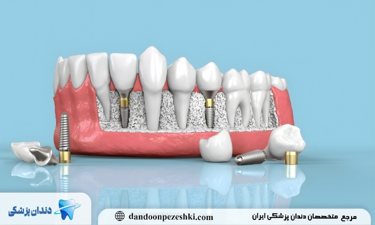 جراحی ایمپلنت