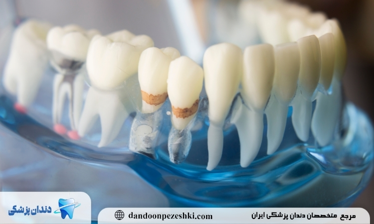 مراقبت بعد از جرم گیری دندان