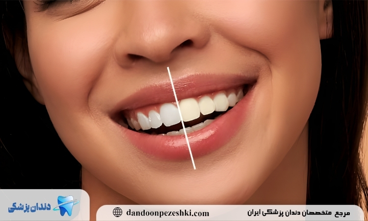 مراقبت های قبل و بعد از بليچينگ