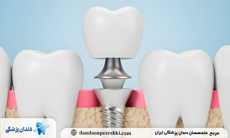 تاج دندان چیست؟
