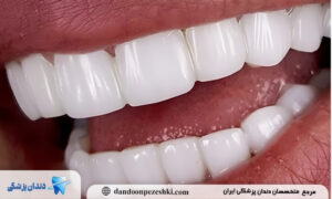 مزایا و معایب لمینت دندان