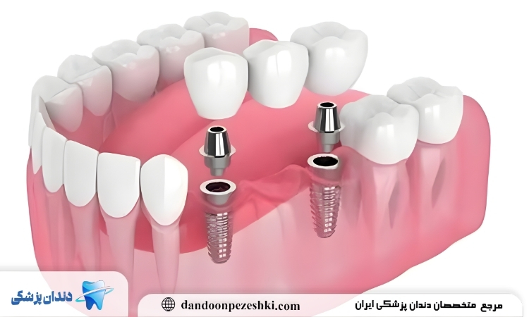 ایمپلنت تک مرحله ای