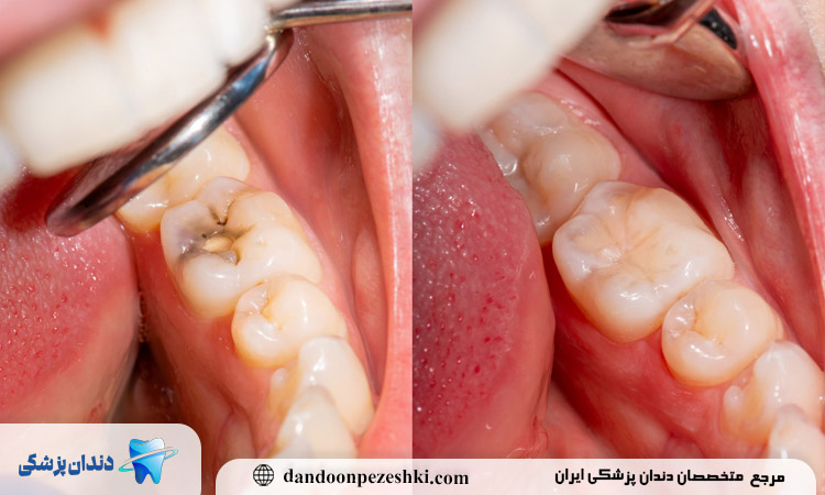 کامپوزیت دندان خراب