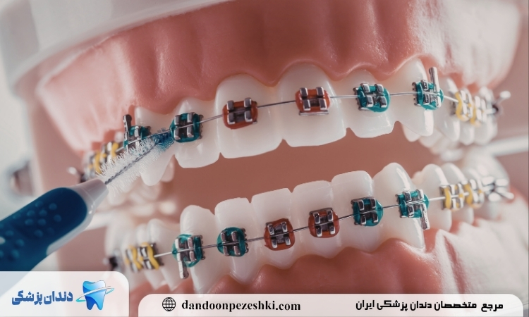 مزایا ارتودنسی دندان