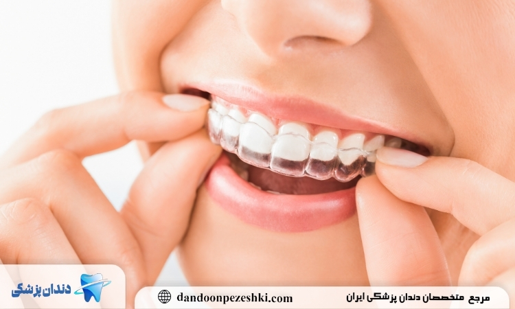 معایب ارتودنسی نامرئی