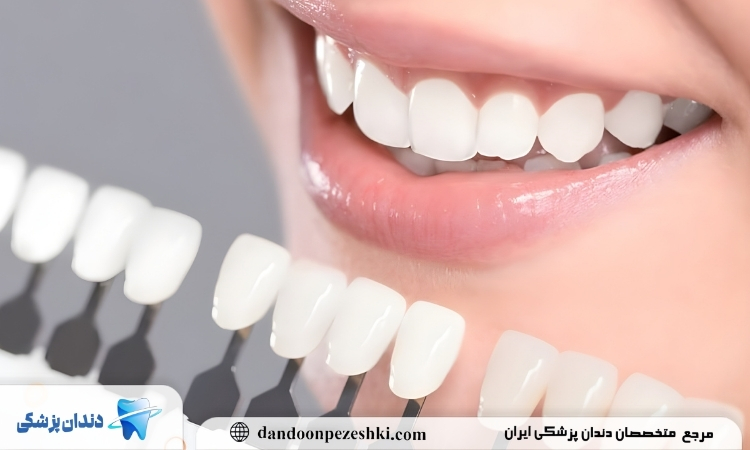 استفاده از لمینت سرامیکی