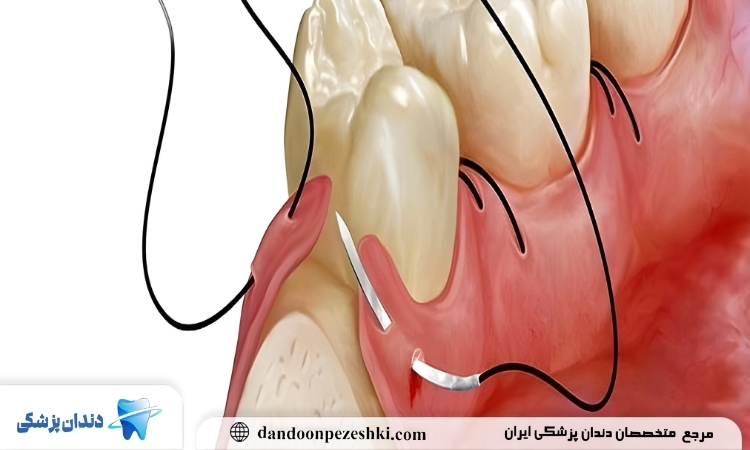 مزایا بخیه کردن