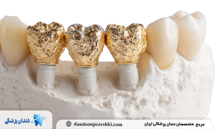 دندان طلا چیست؟