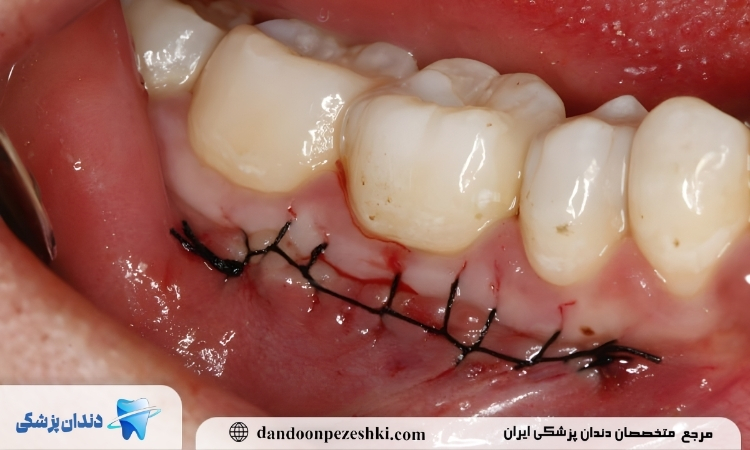 بخیه دندانپزشکی