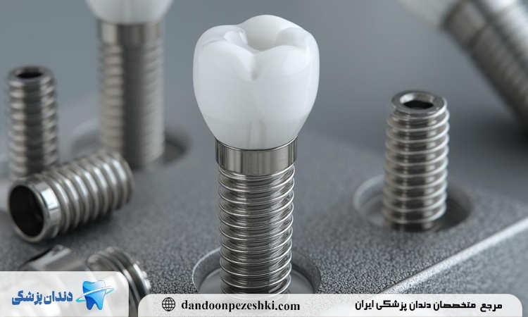 مقایسه ایمپلنت سوئیسی با آلمانی