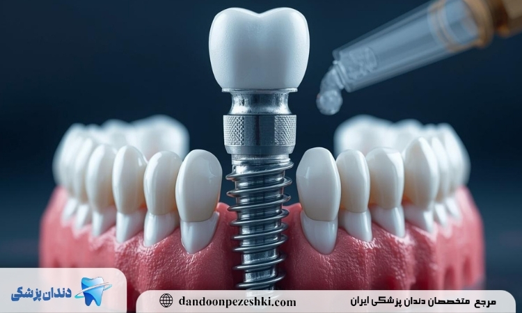 ایمپلنت دندان