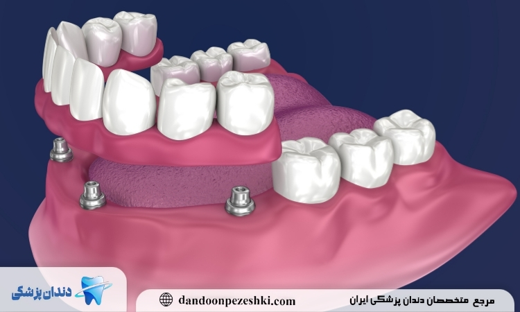 ایمپلنت دندان یا متحرک