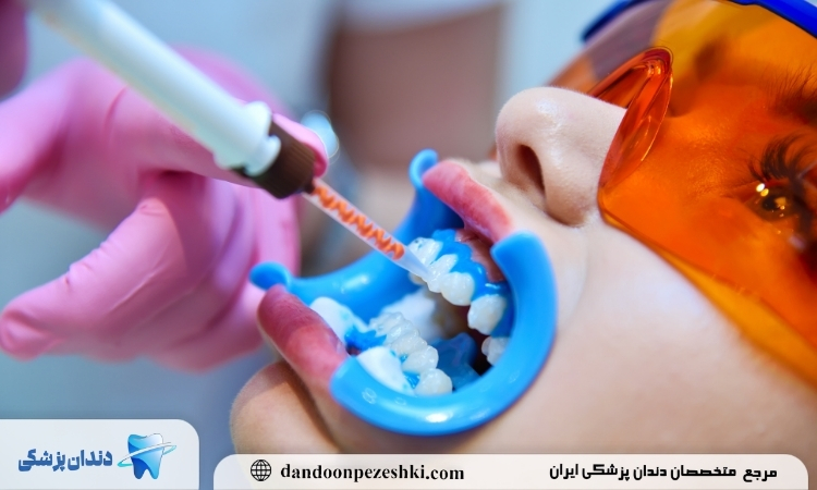 مصرف بلیچینگ دندان