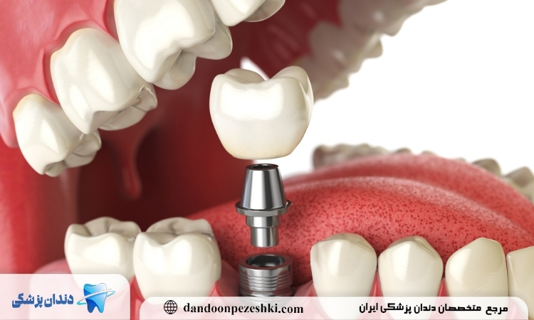 اتصال روکش به ایمپلنت