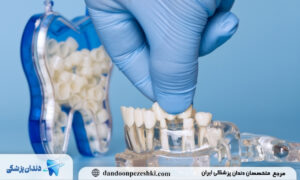 نحوه بریج دندان فک بالا