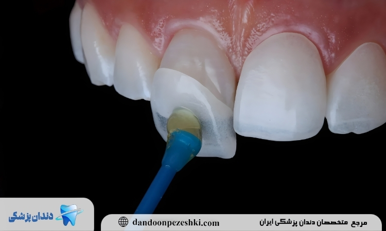 لمینت دندان