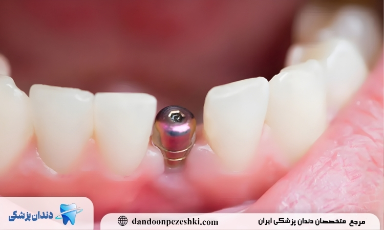 ایمپلنت دندان