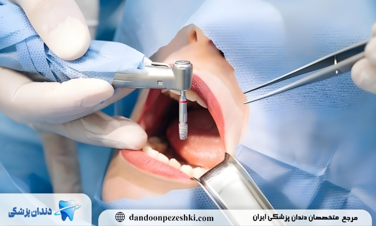 نکاتی درباره جراحی ایمپلنت دندان