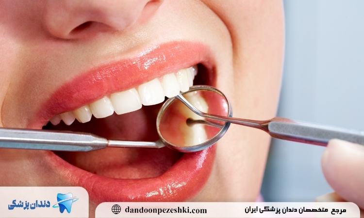 هزینه بریچ دندان