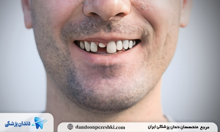 هزینه ترمیم دندان جلو