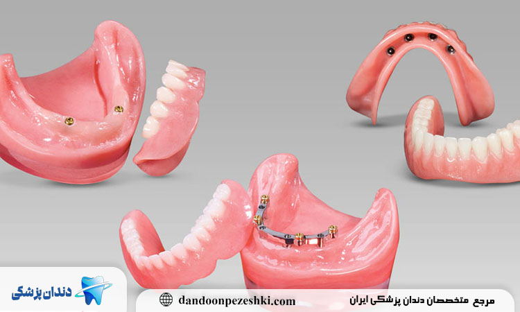 هزینه دست دندان کامل اوردنچر