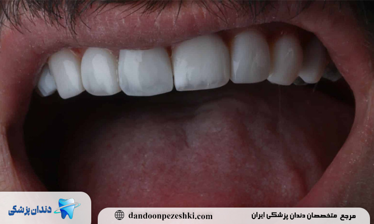 کامپوزیت دندان