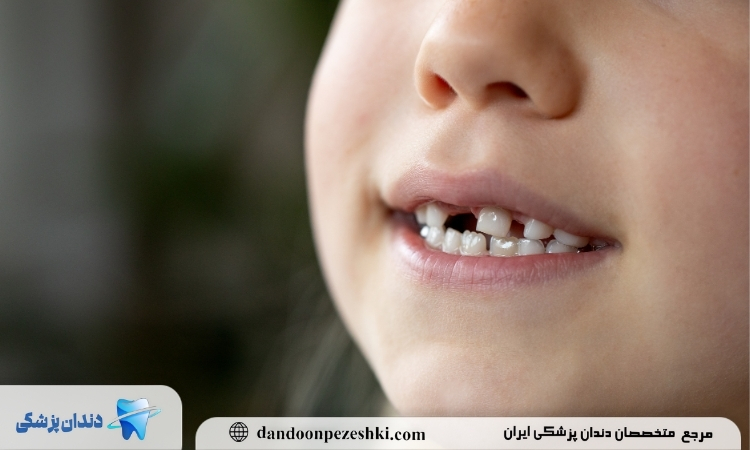 اهمیت دندان 6 در کودکان