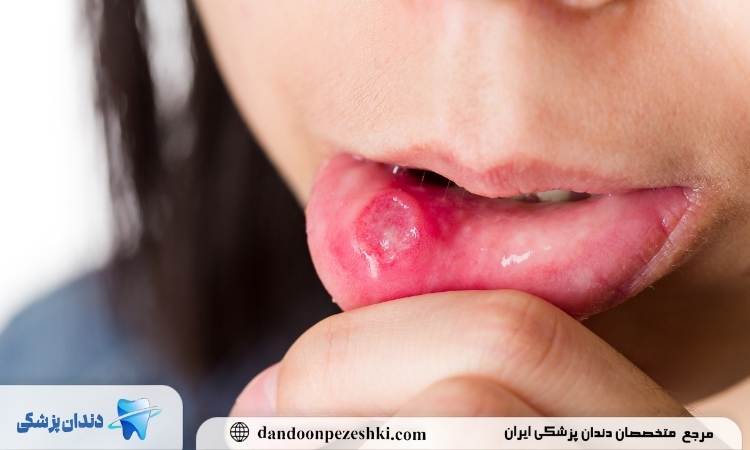 آفت دهان بزرگ