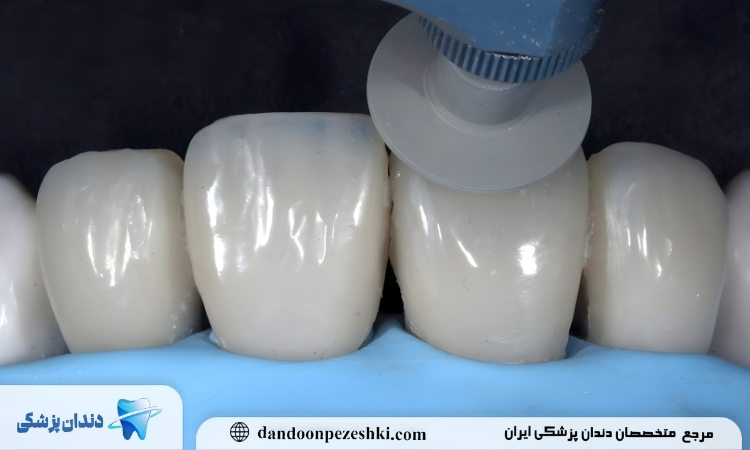کامپوزیت دندان