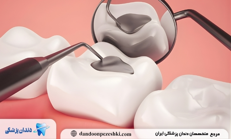 پر کردن دندان