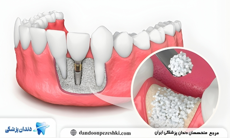 پودر استخوان ایمپلنت چیست؟