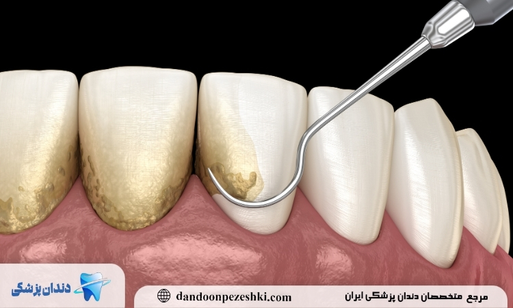جرم گیری دندان 