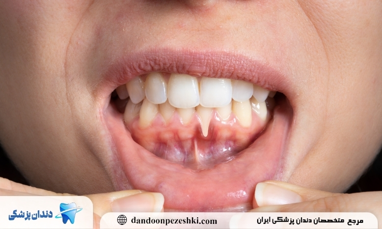 درمان بیماری لثه