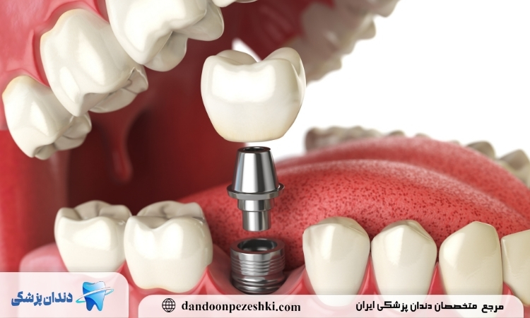 ایمپلنت دندان