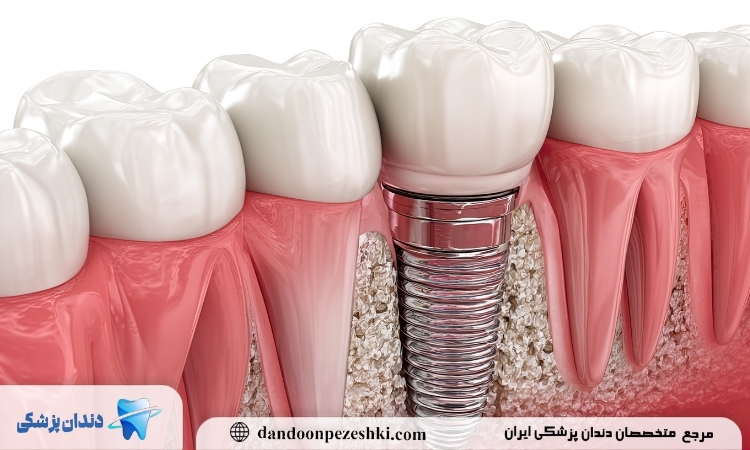 چرا ایمپلنت گران است؟