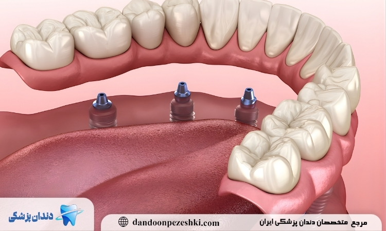 چرا باید جراحی لثه برای ایمپلنت انجام شود؟