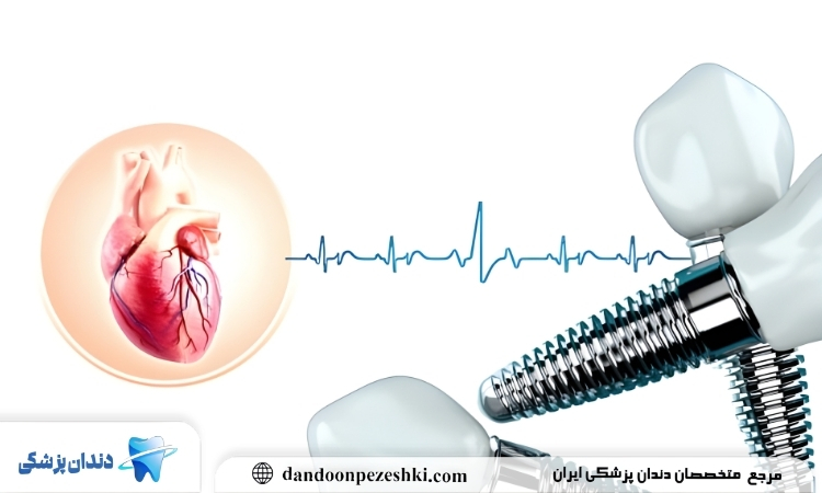 ایمپلنت دندان
