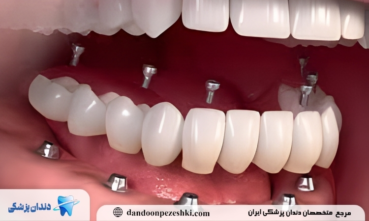 ایمپلنت دندان
